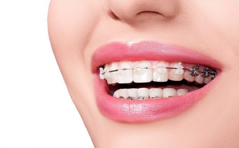 Top 8 nha khoa niềng răng tốt ở TPHCM