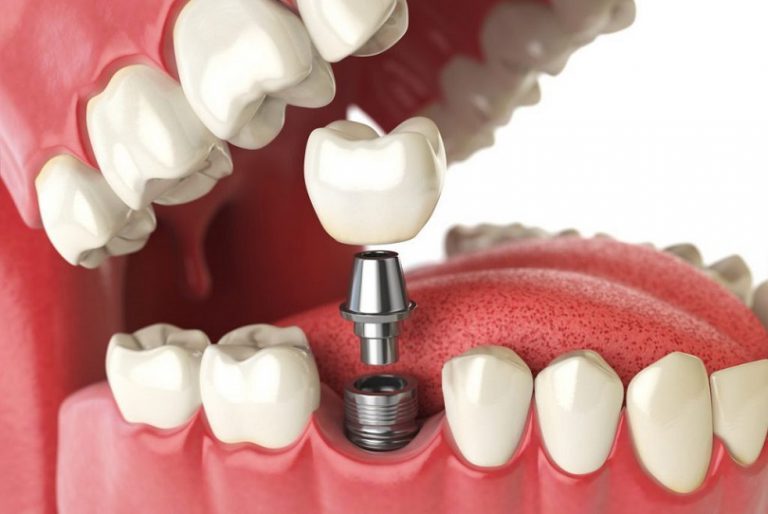 Top 8 dịch vụ trồng răng implant tại TPHCM uy tín hiện nay
